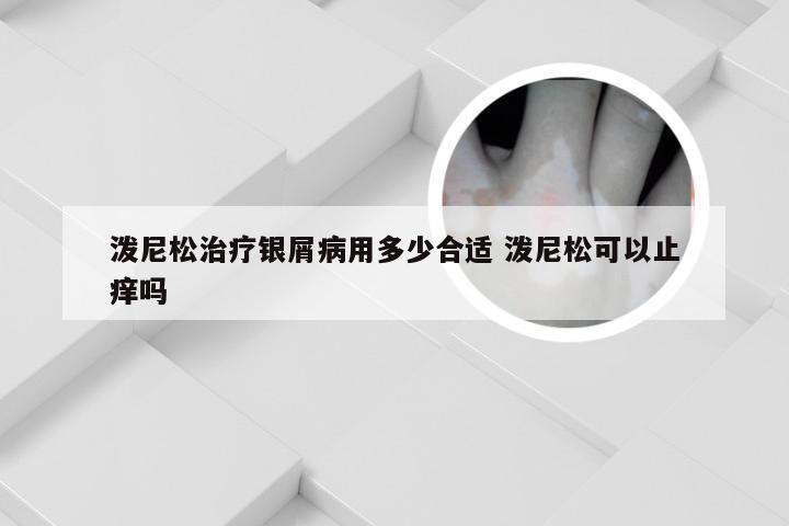 泼尼松治疗银屑病用多少合适 泼尼松可以止痒吗