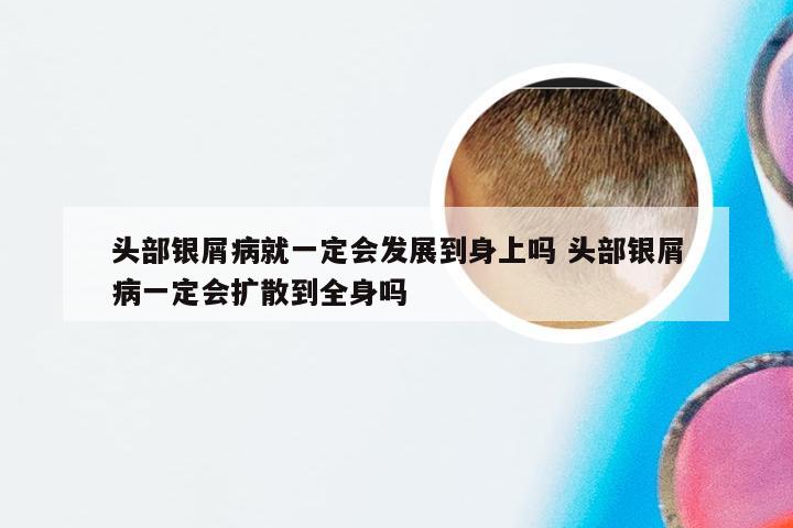 头部银屑病就一定会发展到身上吗 头部银屑病一定会扩散到全身吗