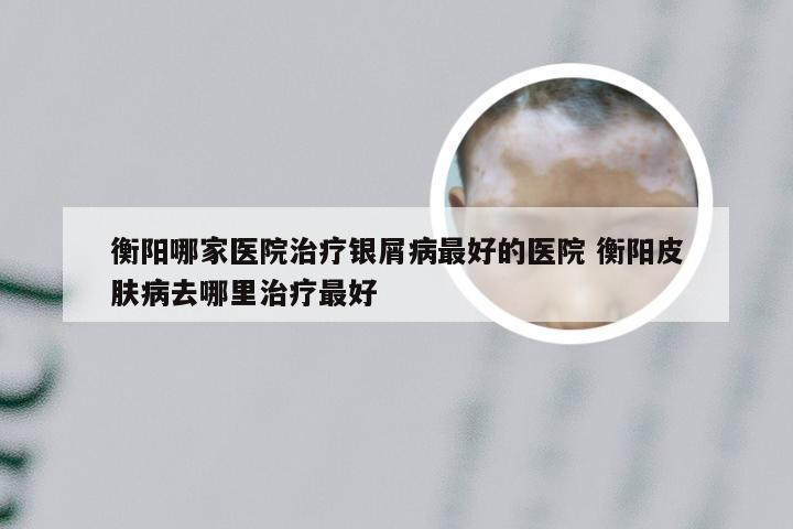 衡阳哪家医院治疗银屑病最好的医院 衡阳皮肤病去哪里治疗最好