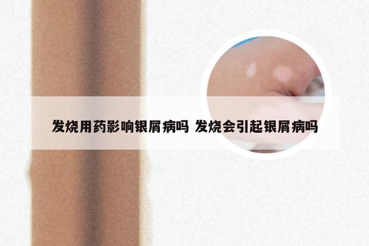 发烧用药影响银屑病吗 发烧会引起银屑病吗