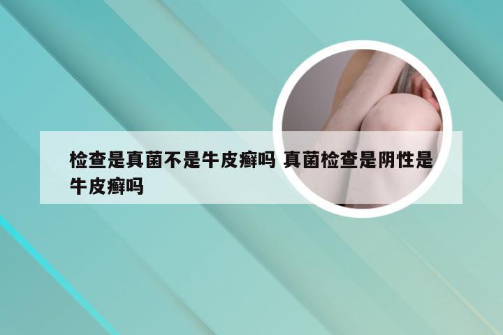 检查是真菌不是牛皮癣吗 真菌检查是阴性是牛皮癣吗