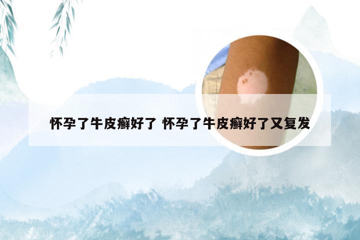 怀孕了牛皮癣好了 怀孕了牛皮癣好了又复发