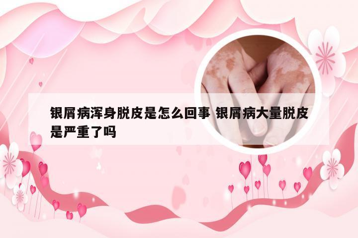 银屑病浑身脱皮是怎么回事 银屑病大量脱皮是严重了吗