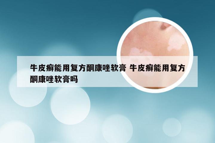 牛皮癣能用复方酮康唑软膏 牛皮癣能用复方酮康唑软膏吗
