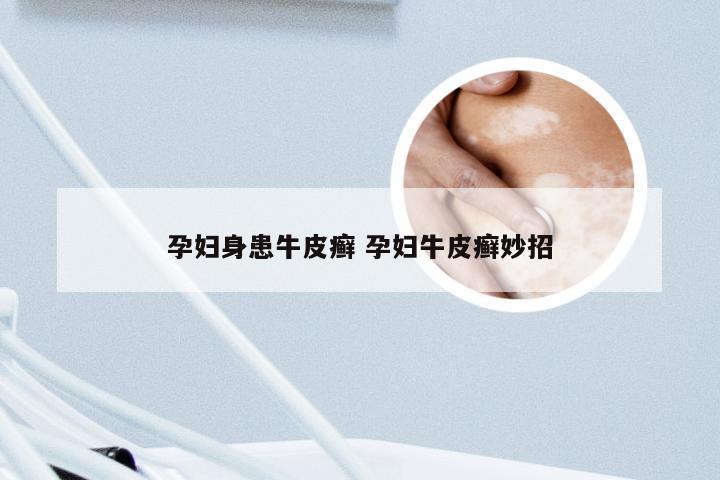 孕妇身患牛皮癣 孕妇牛皮癣妙招