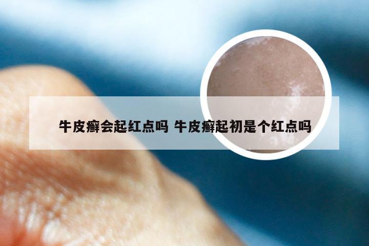 牛皮癣会起红点吗 牛皮癣起初是个红点吗