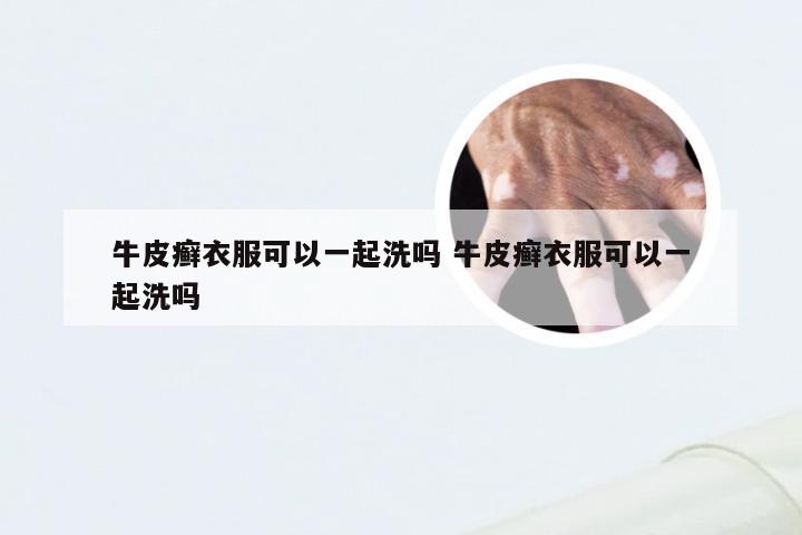 牛皮癣衣服可以一起洗吗 牛皮癣衣服可以一起洗吗