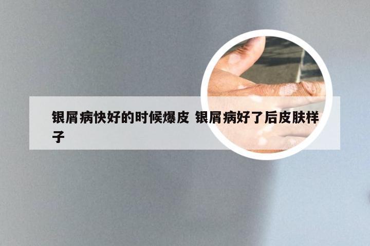 银屑病快好的时候爆皮 银屑病好了后皮肤样子