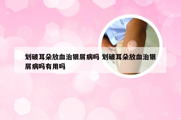 划破耳朵放血治银屑病吗 划破耳朵放血治银屑病吗有用吗