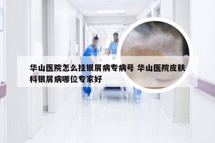 华山医院怎么挂银屑病专病号 华山医院皮肤科银屑病哪位专家好