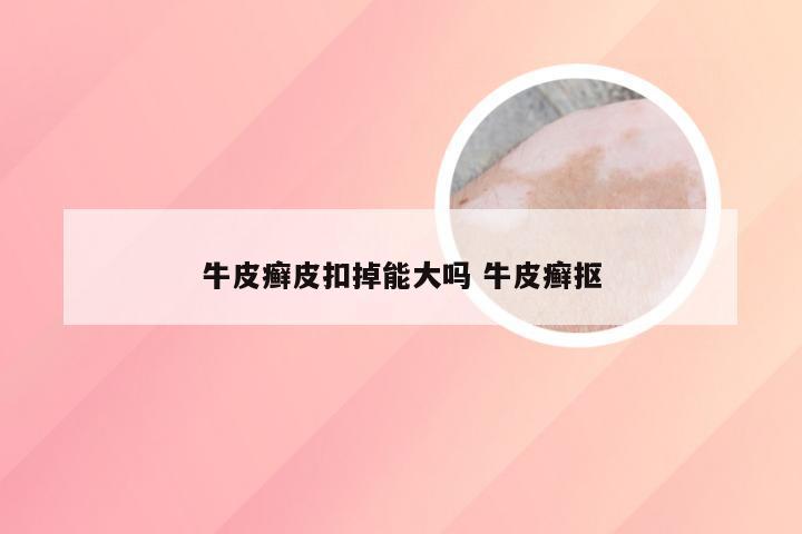 牛皮癣皮扣掉能大吗 牛皮癣抠
