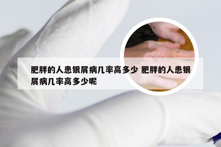 肥胖的人患银屑病几率高多少 肥胖的人患银屑病几率高多少呢