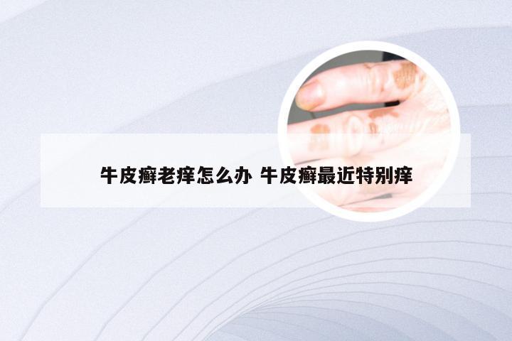 牛皮癣老痒怎么办 牛皮癣最近特别痒