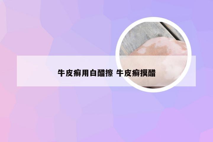 牛皮癣用白醋擦 牛皮癣摸醋
