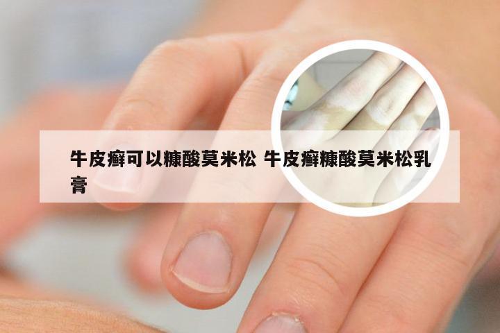 牛皮癣可以糠酸莫米松 牛皮癣糠酸莫米松乳膏