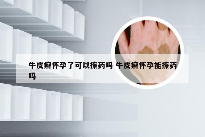 牛皮癣怀孕了可以擦药吗 牛皮癣怀孕能擦药吗