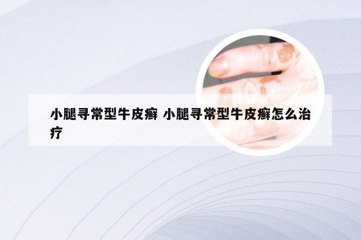 小腿寻常型牛皮癣 小腿寻常型牛皮癣怎么治疗