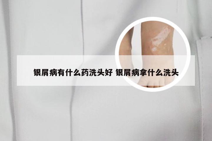 银屑病有什么药洗头好 银屑病拿什么洗头