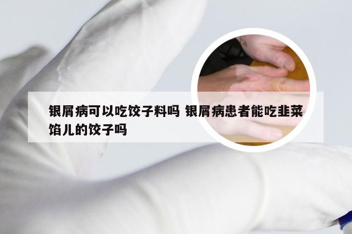 银屑病可以吃饺子料吗 银屑病患者能吃韭菜馅儿的饺子吗
