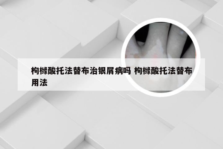 枸橼酸托法替布治银屑病吗 枸橼酸托法替布用法