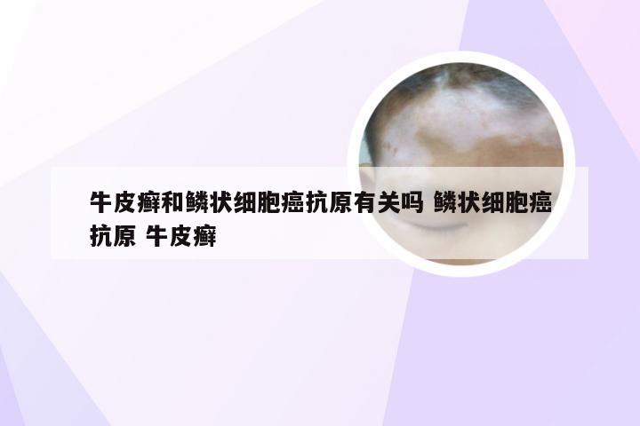 牛皮癣和鳞状细胞癌抗原有关吗 鳞状细胞癌抗原 牛皮癣