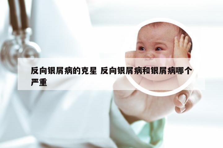 反向银屑病的克星 反向银屑病和银屑病哪个严重