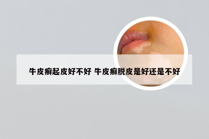 牛皮癣起皮好不好 牛皮癣脱皮是好还是不好