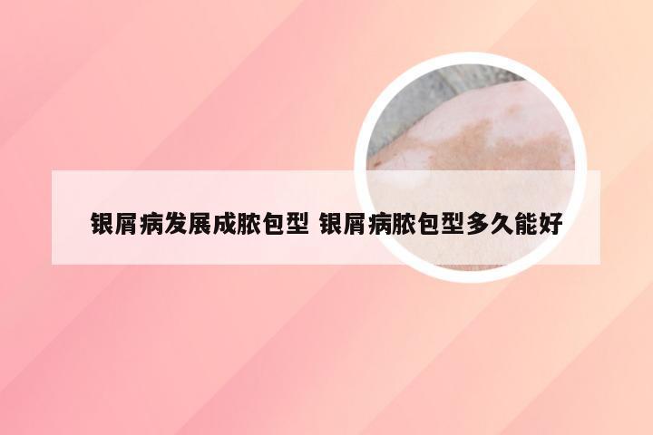 银屑病发展成脓包型 银屑病脓包型多久能好