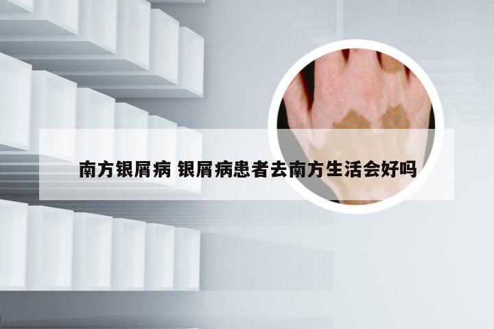 南方银屑病 银屑病患者去南方生活会好吗