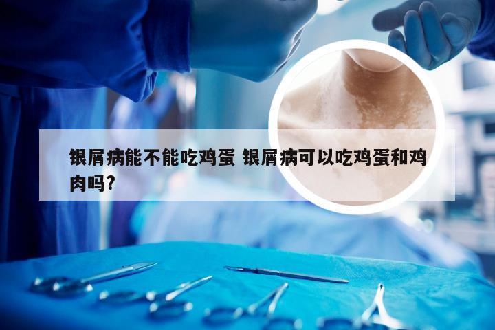 银屑病能不能吃鸡蛋 银屑病可以吃鸡蛋和鸡肉吗?