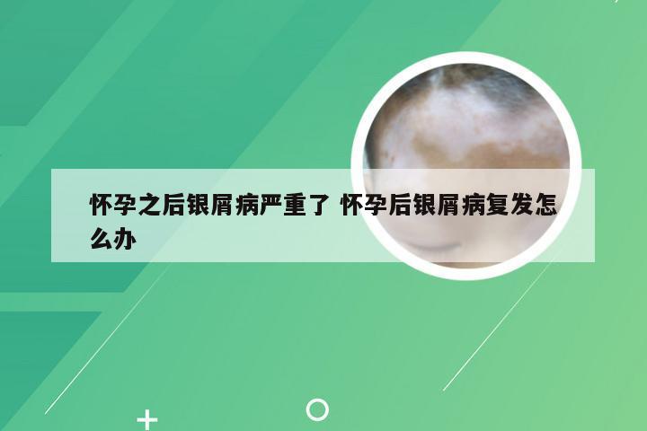 怀孕之后银屑病严重了 怀孕后银屑病复发怎么办