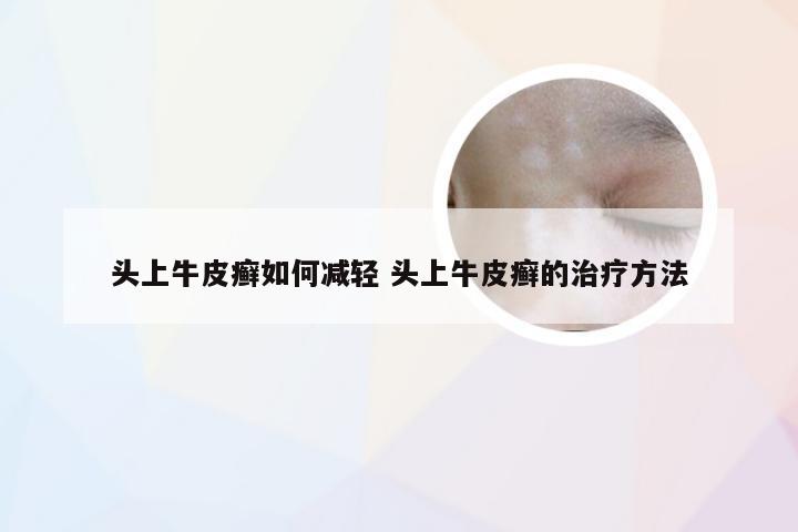 头上牛皮癣如何减轻 头上牛皮癣的治疗方法