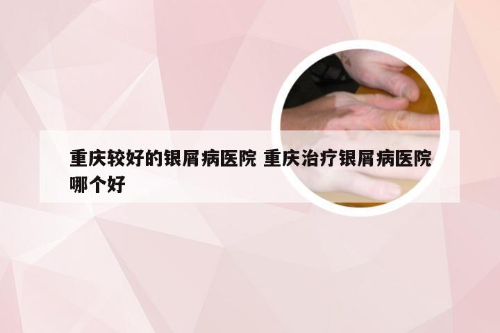 重庆较好的银屑病医院 重庆治疗银屑病医院哪个好