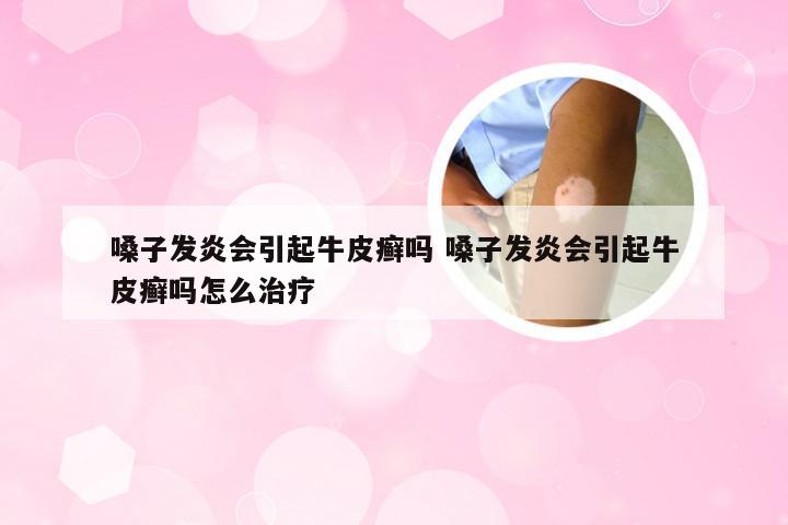 嗓子发炎会引起牛皮癣吗 嗓子发炎会引起牛皮癣吗怎么治疗