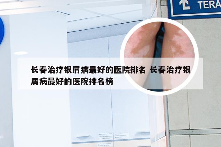 长春治疗银屑病最好的医院排名 长春治疗银屑病最好的医院排名榜