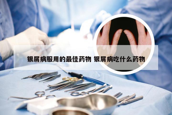 银屑病服用的最佳药物 银屑病吃什么药物
