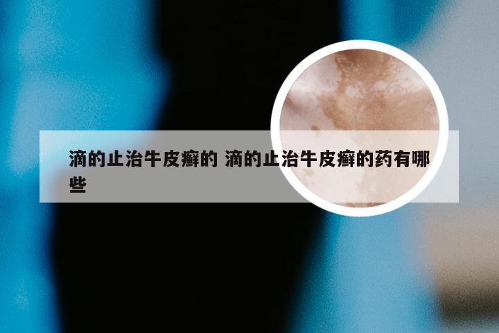 滴的止治牛皮癣的 滴的止治牛皮癣的药有哪些