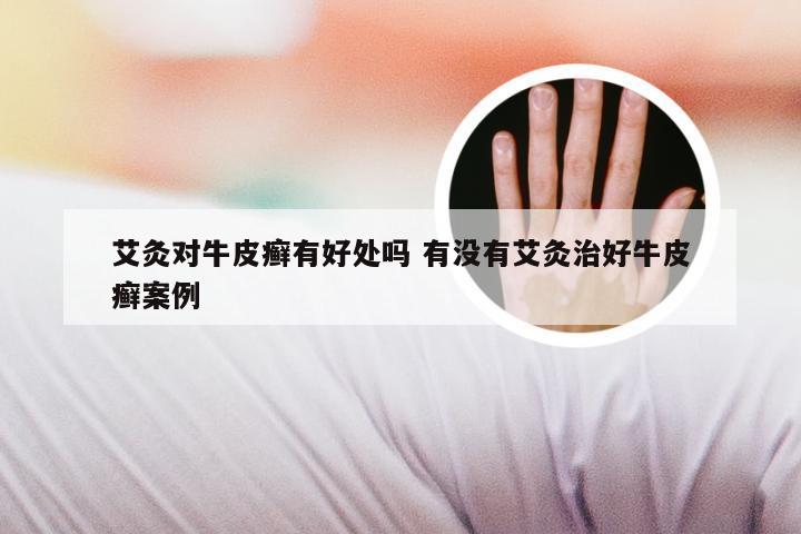 艾灸对牛皮癣有好处吗 有没有艾灸治好牛皮癣案例