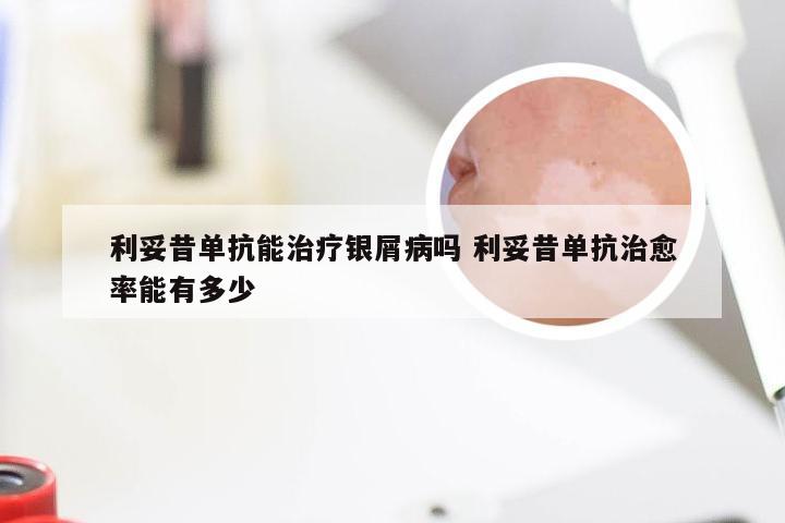 利妥昔单抗能治疗银屑病吗 利妥昔单抗治愈率能有多少