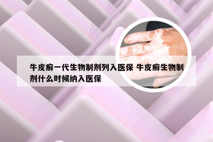 牛皮癣一代生物制剂列入医保 牛皮癣生物制剂什么时候纳入医保