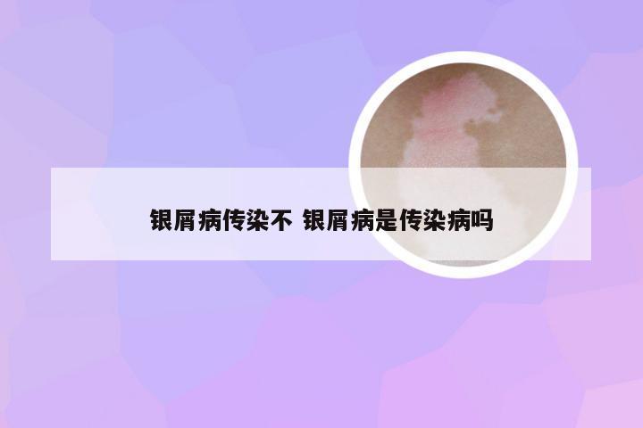银屑病传染不 银屑病是传染病吗