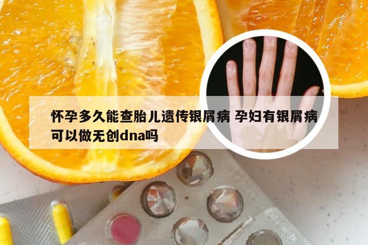 怀孕多久能查胎儿遗传银屑病 孕妇有银屑病可以做无创dna吗