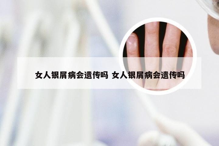女人银屑病会遗传吗 女人银屑病会遗传吗
