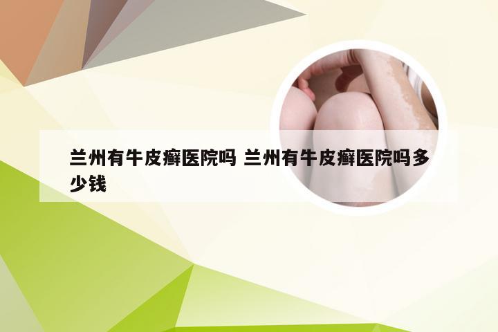 兰州有牛皮癣医院吗 兰州有牛皮癣医院吗多少钱
