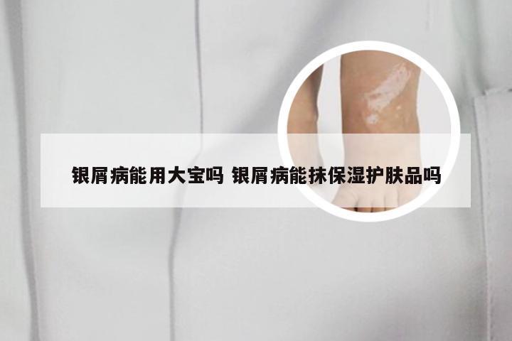 银屑病能用大宝吗 银屑病能抹保湿护肤品吗