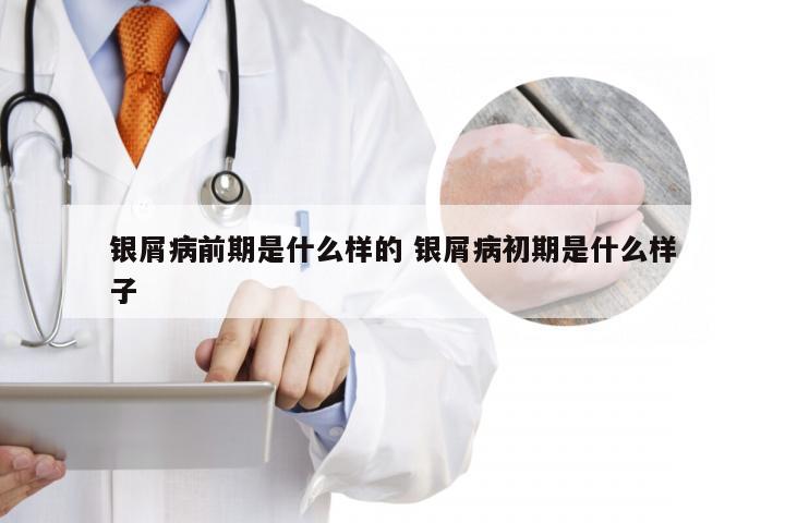 银屑病前期是什么样的 银屑病初期是什么样子