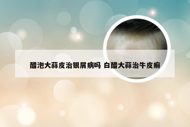 醋泡大蒜皮治银屑病吗 白醋大蒜治牛皮癣