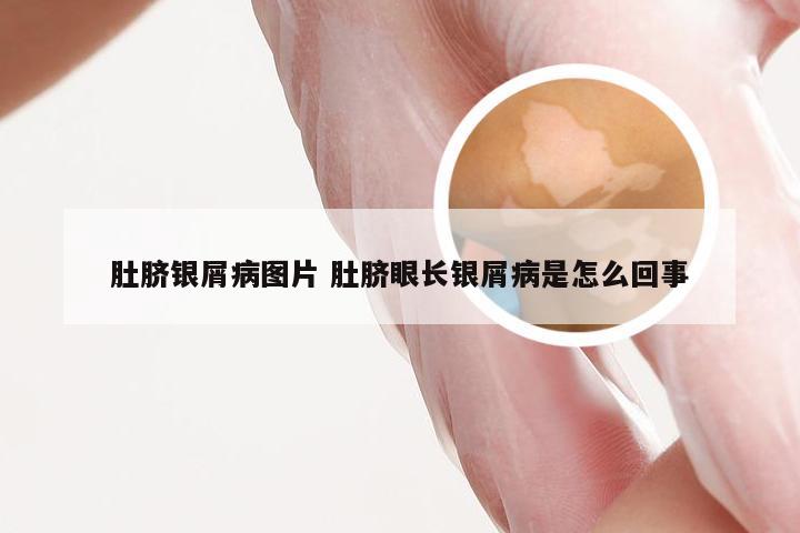 肚脐银屑病图片 肚脐眼长银屑病是怎么回事