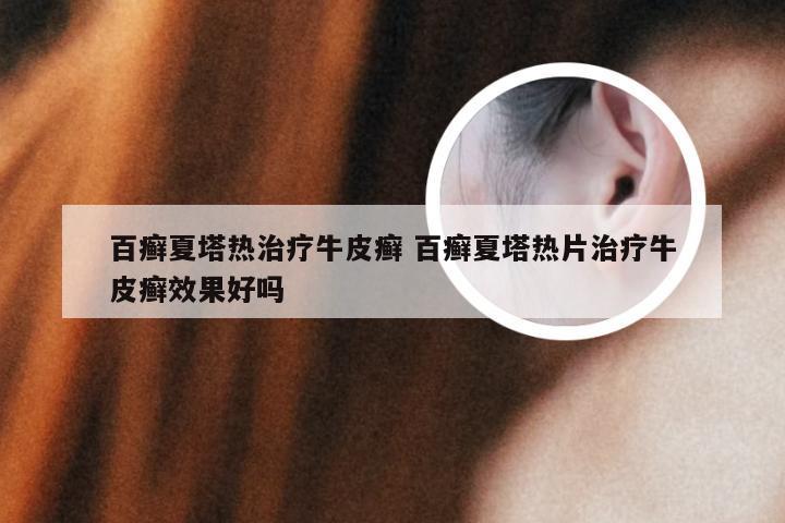百癣夏塔热治疗牛皮癣 百癣夏塔热片治疗牛皮癣效果好吗