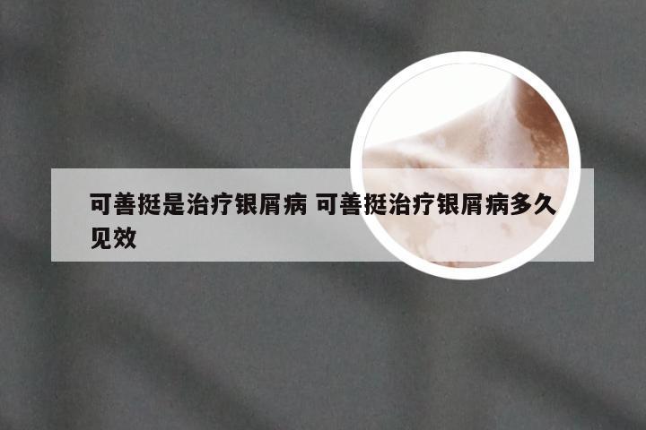 可善挺是治疗银屑病 可善挺治疗银屑病多久见效